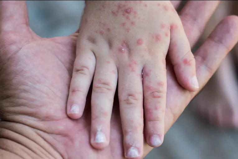 Brote de virus Coxsackie en escuela de Concordia: suspendieron las clases y reforzaron las medidas sanitarias