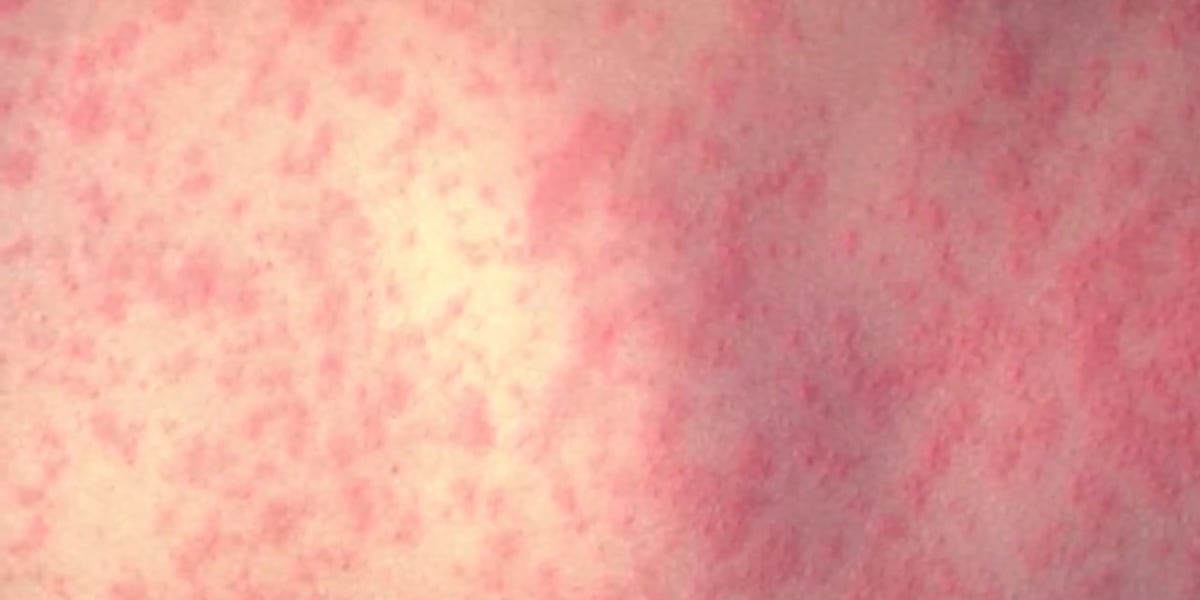 Passenger with contagious measles passed Sunday through Armstrong New Orleans airport, LDH says