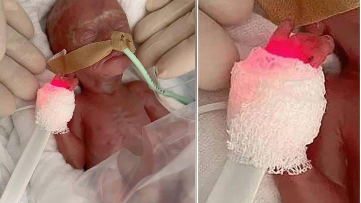 ¡Un milagro! Bebé que nació 16 semanas antes de tiempo y con un peso de 300 gramos revoluciona la medicina alemana