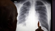 Virginia improves in lung cancer outcomes but lags in early detection and testing access