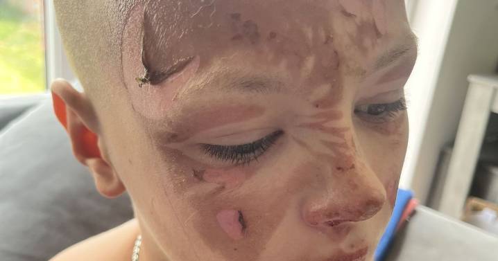 Boy suffers burns to face and legs after aerosol thrown onto bonfire