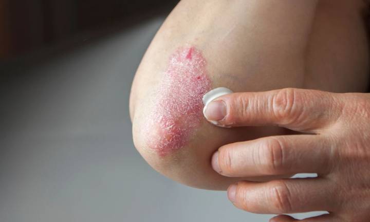 Patients with coexisting psoriasis and diabetes face elevated all
