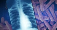 Global tuberculosis diagnoses rise to a record, but deaths fall, WHO reports