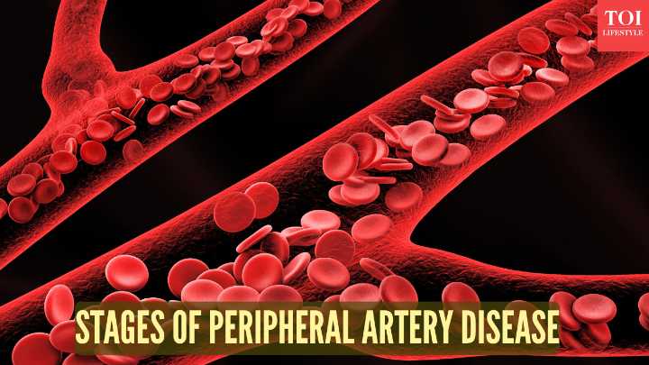 4 stages of peripheral artery disease: From mild circulation issues to critical limb ischemia