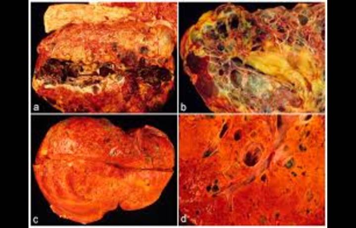 Autosomal Dominant Polycystic Kidney Disease Associated with Better Dialysis Survival: Study