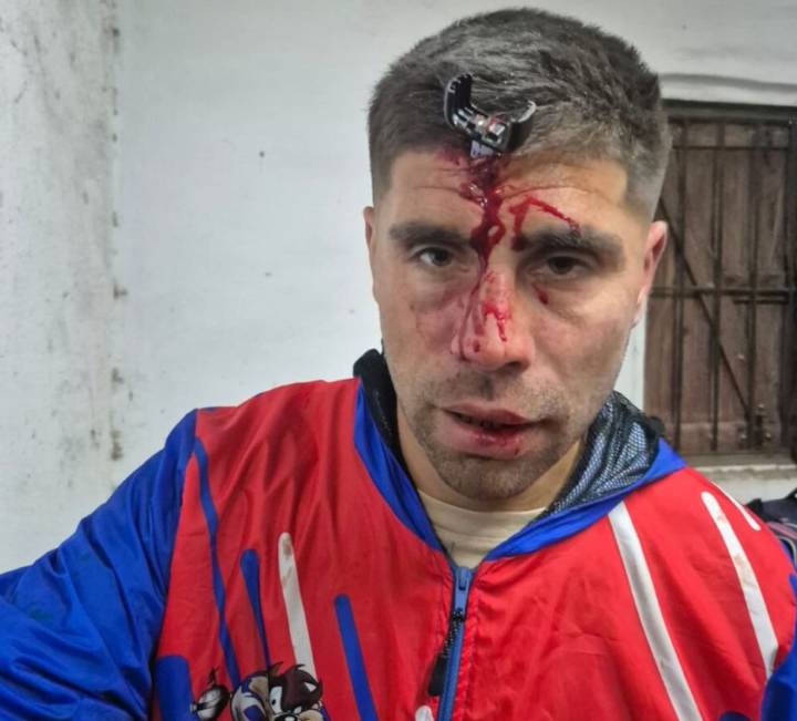 Violencia en el fútbol. Le clavaron una llave en la cabeza, le fracturaron el cráneo y rompió el silencio: “Se fue todo de las manos”