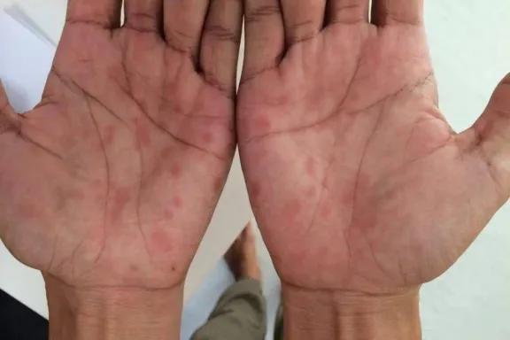 Neuquén desmiente un aumento desproporcionado de casos de sífilis: se trató de un error técnico