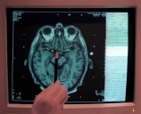 A charity offered free MRIs to screen for brain cancer. Doctors worry they’re not worth the risks