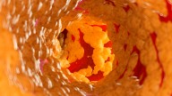 New Drug Lowers 'Bad' Cholesterol by 58% in Clinical Trial