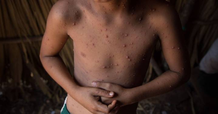 Varicela se ‘expande’ en Quintana Roo: Van 992 casos confirmados