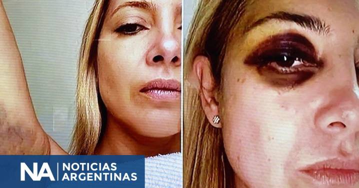 Fabiola Yañez ratificó que Alberto Fernández la golpeó: “Ese ojo morado existió”