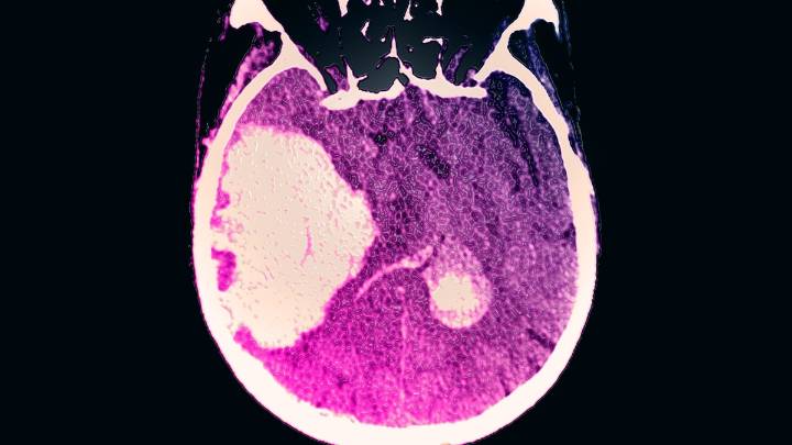Heavy drinking linked to deadlier brain hemorrhages