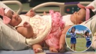 Formerly conjoined twin sisters defy the odds