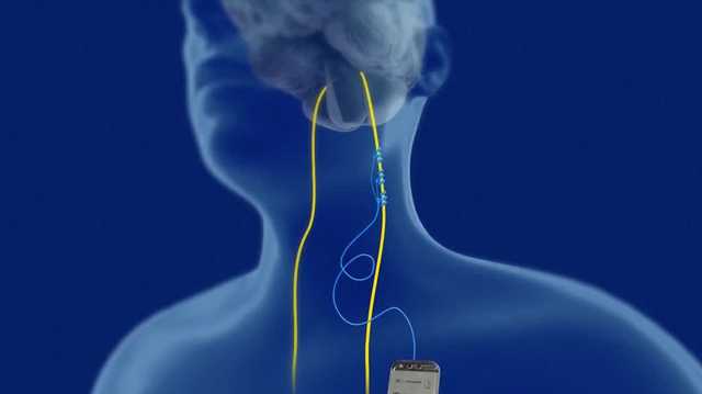 Stroke survivor uses nerve implant to regain lost abilities