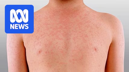 Measles warning issued for South West and Great Southern as confirmed case numbers climb