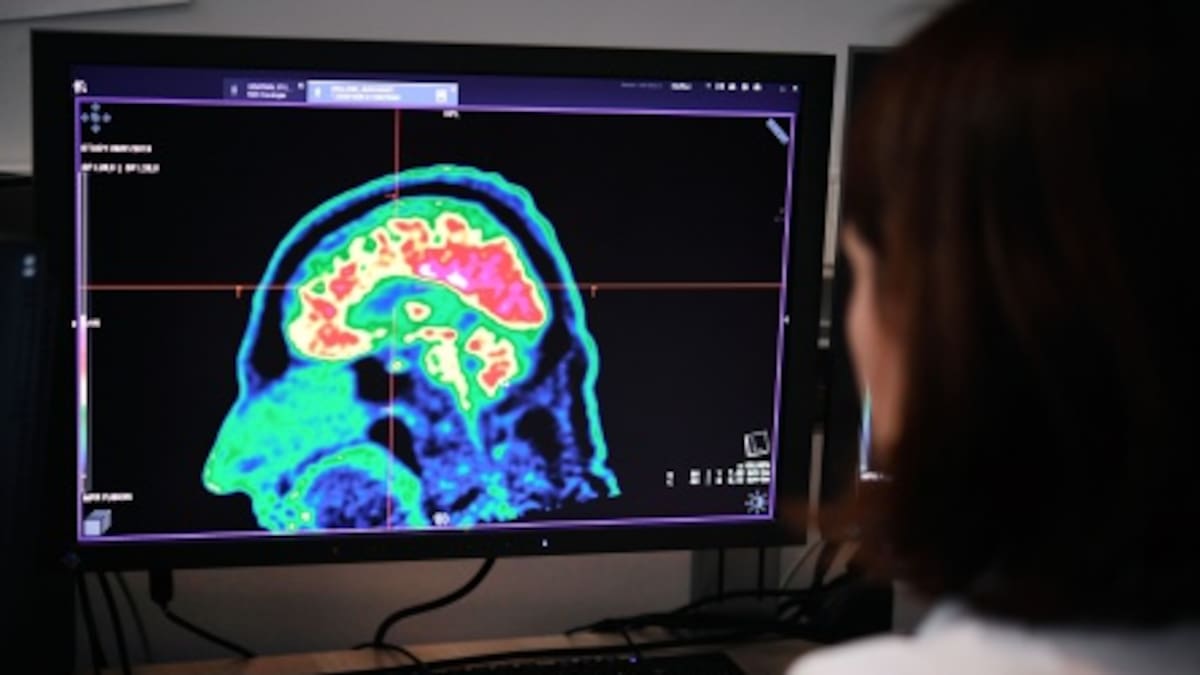 El mapa del desarrollo cerebral que abre la puerta a tratar trastornos incurables