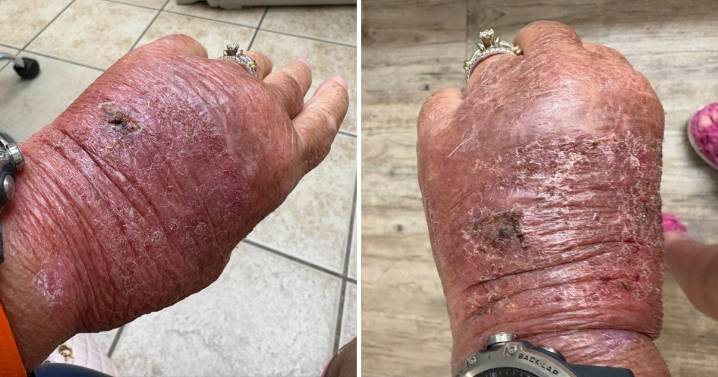 Paper Cut Turns Into Massive Infection On Woman's Hand: EXLUSIVE