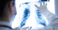 UK Markey Cancer Center Programs drive lung cancer screening improvements