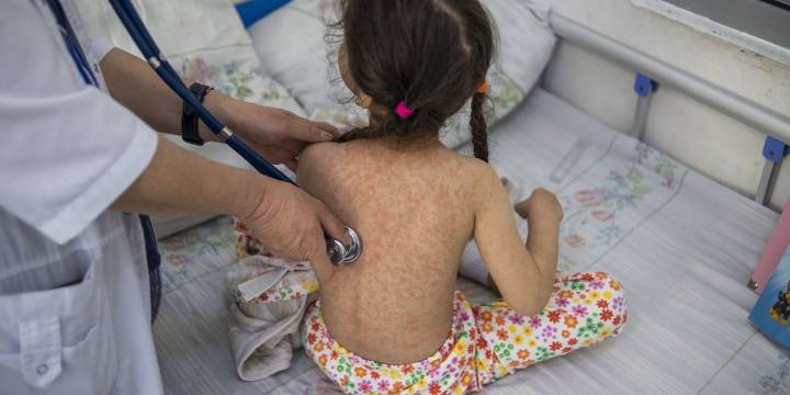 Sarampión en México: Salud reporta 74 casos activos en todo el país