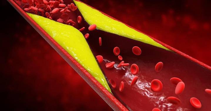 Most People Aren't Aware Of Genetic Risk For Dangerously High Cholesterol