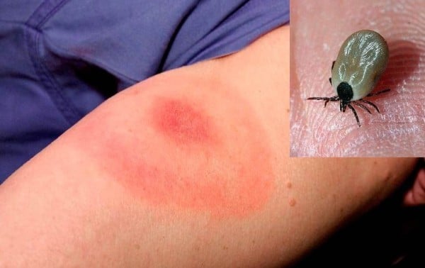 Aumenta la incidencia de rickettsiosis en el estado