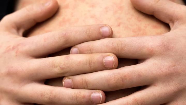 Crisis por sarampión en México: es el país con más muertes en América