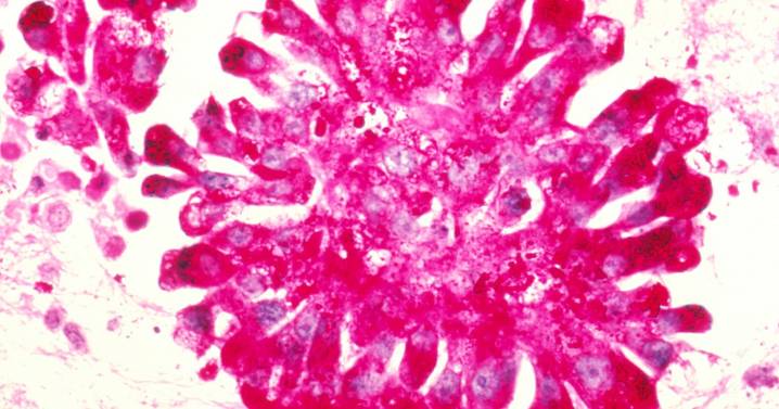 Identifican la célula de origen de un tumor pediátrico muy agresivo