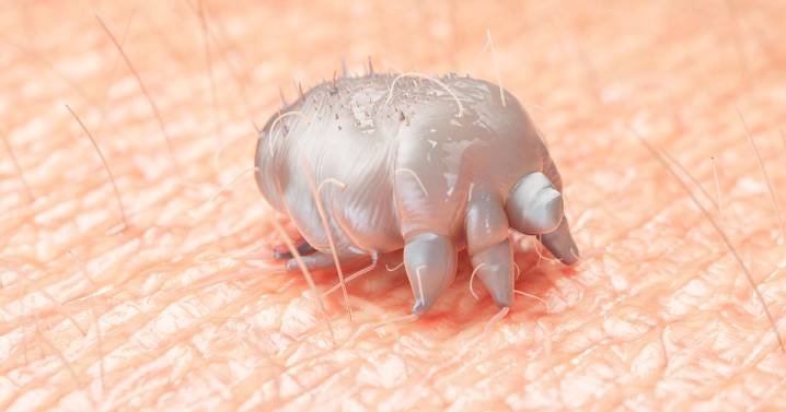 Scabies surges in UK as cases of parasitic medieval skin disease double