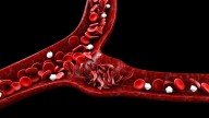 Agios reports mixed results from sickle cell study of Pyrukynd