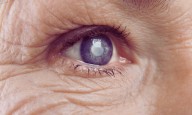 Age-Related Eye Diseases Raise Risk of Heart Disease–Depression Combo, Long