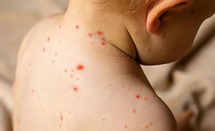 Alerta nacional por brote de sarampión: un grupo de turistas contagiados viajó por siete provincias en micros de larga distancia