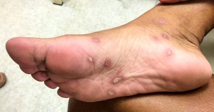 Los jóvenes siguen concentrando la mitad de los casos de sífilis en Salta