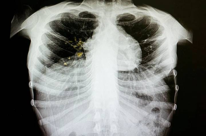 Tuberculosis outbreak declared in inner-city Edmonton: Primary Care Alberta