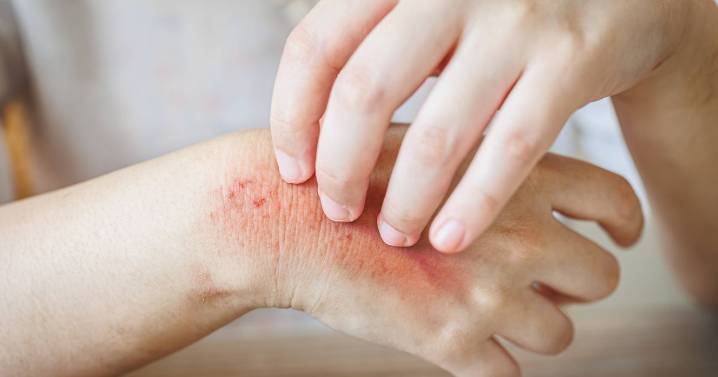 New eczema treatment approved for NHS use 'will help 62,000'