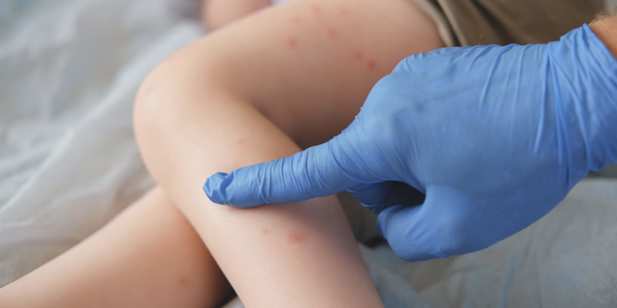 Avera Medical Minute: What is Molluscum?