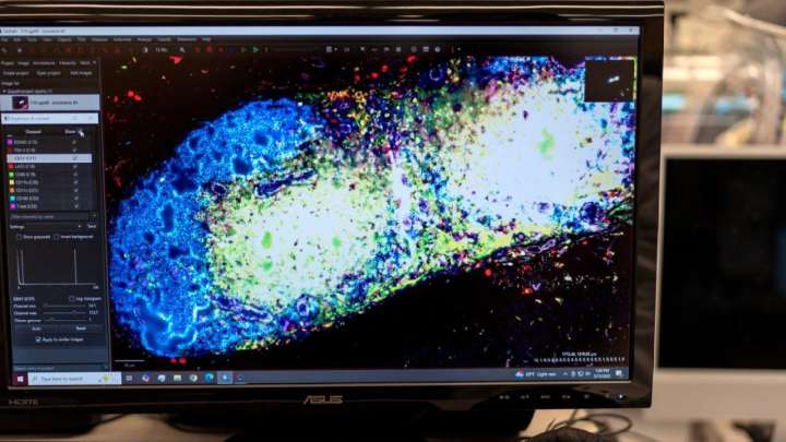 Researchers try bold new approach in race to treat autoimmune diseases