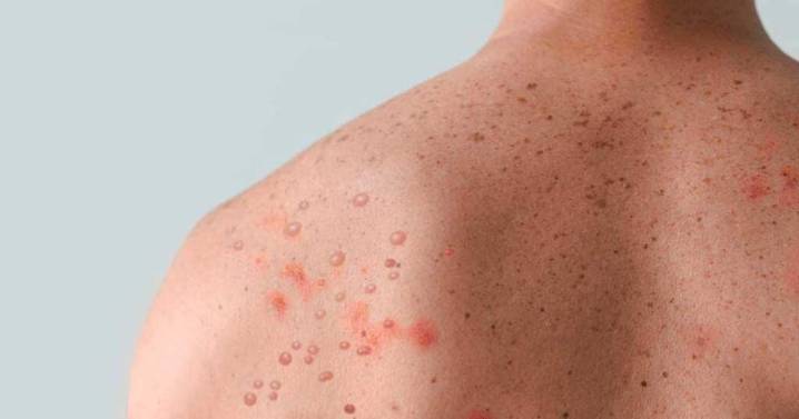 Querétaro suma 11 casos de sarampión; confirman primer contagio en la capital