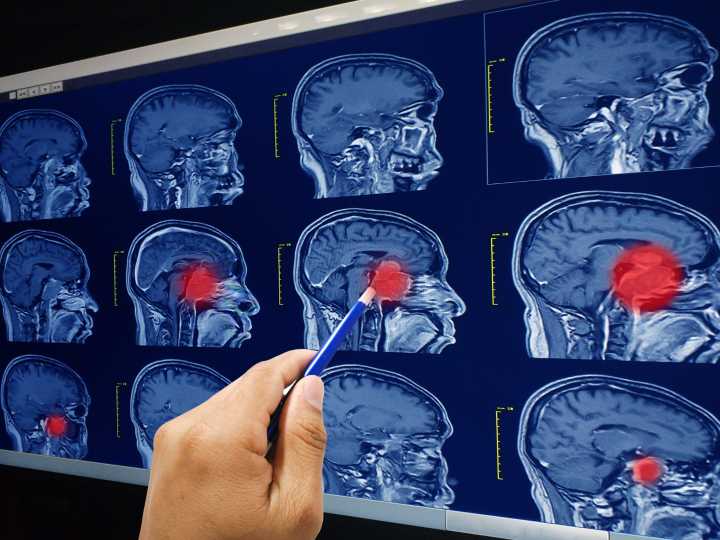 Hallan una causa inesperada en el cerebro por la que el cáncer es muchas veces resistente a la quimioterapia
