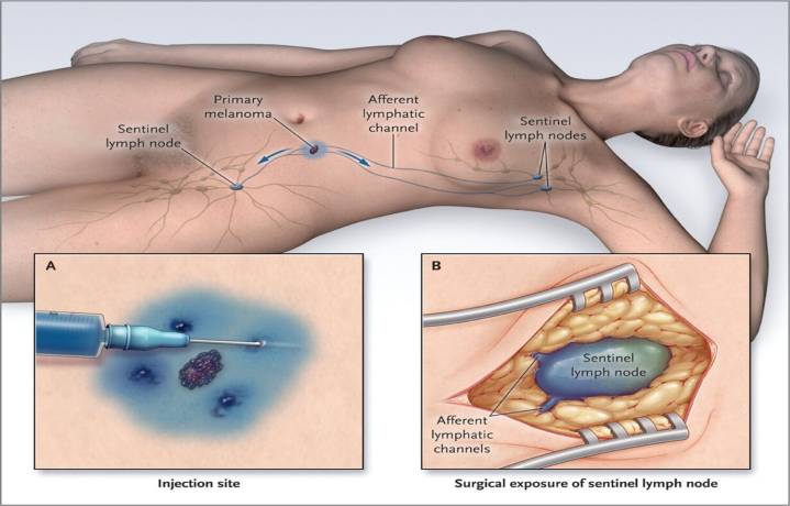 Sentinel Lymph Node Biopsy Alone Matches full Lymphadenectomy for disease free survival in Early...