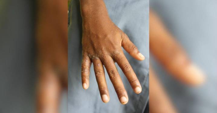 Infografía | La sarna: plaga del pasado, amenaza actual