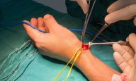 Subcutaneous nitroglycerin effectively prevents radial artery occlusion in children: JAMA