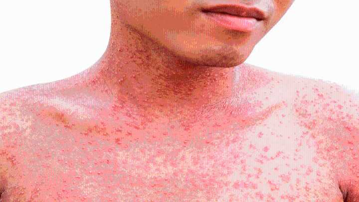 Alerta epidemiológica por nuevos casos de sarampión