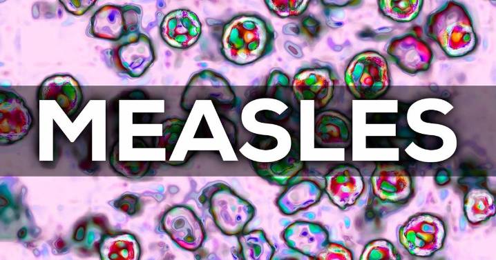 Metro Public Health Department confirms measles case in Nashville