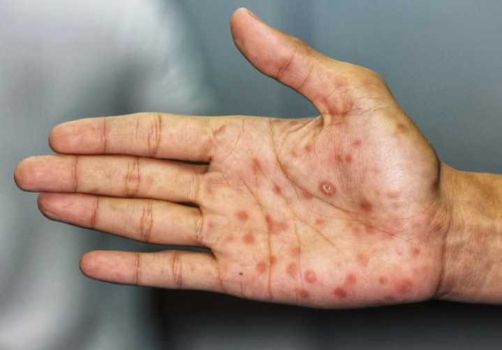 San Luis reportó 856 contagios de sífilis en 2024 y ocupa el segundo lugar nacional