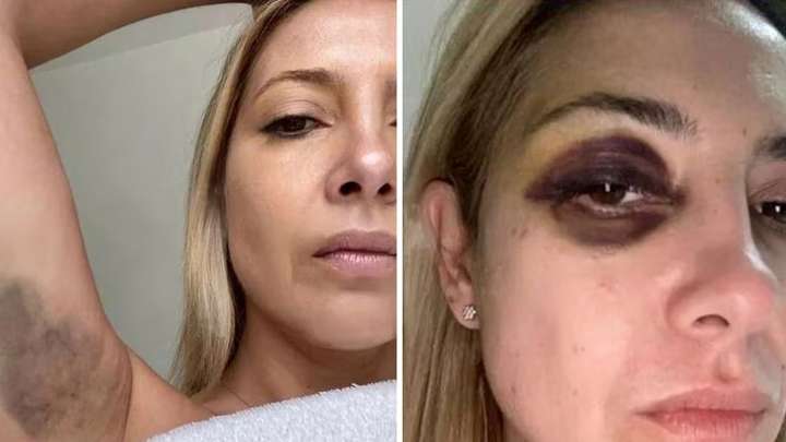 Fabiola Yáñez reveló si fue mentira lo de sus fotos con el ojo morado y moretones