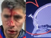 Le clavaron una llave en la cabeza a un futbolista del Ascenso durante una salvaje pelea en un torneo de fútbol femenino