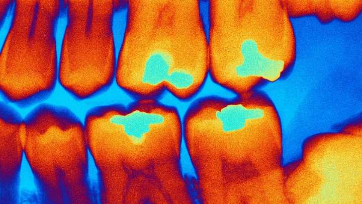 Sweeping Tooth Fillings Ban Will Change Dentistry Around The World