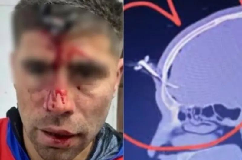 "¡Dejen de pegarle!": el desesperado relato de la mujer que vio cómo le clavaron una llave en la cabeza a su marido