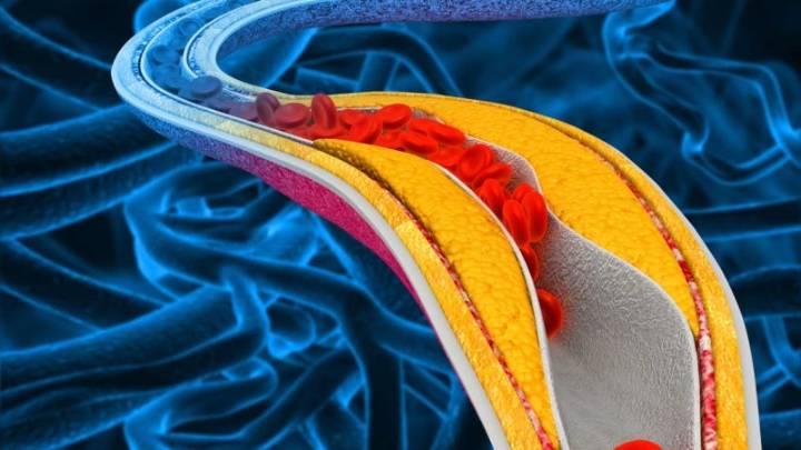 Una píldora podría reducir el colesterol en pacientes que no obtienen suficiente beneficio solo con estatinas, según estudio