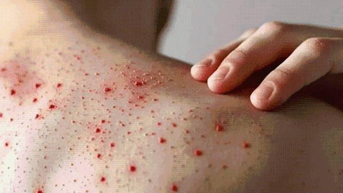 Alertan por casos de sarampión: los síntomas a tener en cuenta